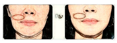 玻尿酸注射祛法令紋