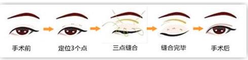 做韓式三點式雙眼皮手術(shù)果好嗎？