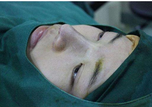 為什么鼻部手術(shù)比單純隆鼻術(shù)術(shù)更好看?