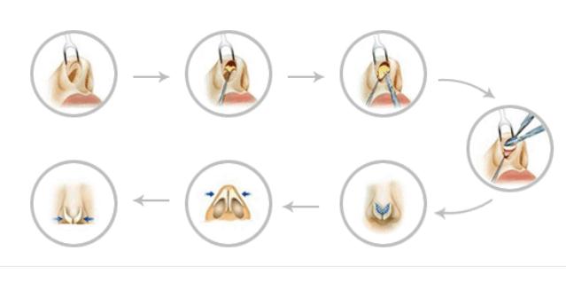 單純隆鼻術(shù)