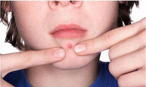 激光調(diào)節(jié)痤瘡之后會復(fù)發(fā)嗎？擔(dān)心痘痘反反復(fù)復(fù)