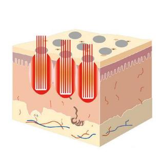 激光調(diào)節(jié)痤瘡