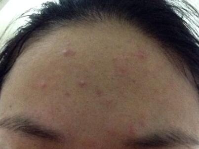 激光調(diào)節(jié)后痤瘡會復(fù)發(fā)嗎?