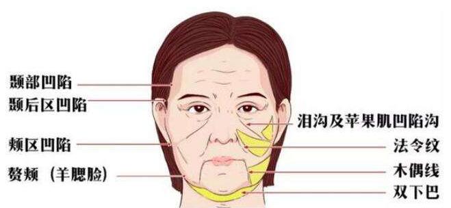 什么是自體脂肪面部填充？