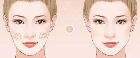 自體脂肪面部填充術(shù)后的預(yù)防措施