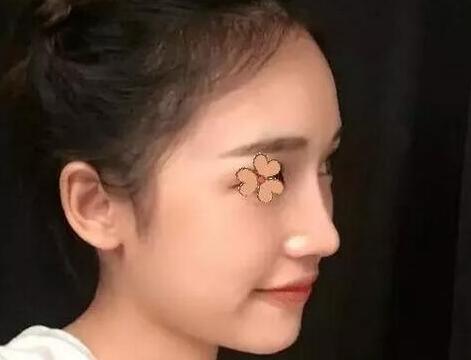 韓國ohkims整形外科醫(yī)院隆鼻案例