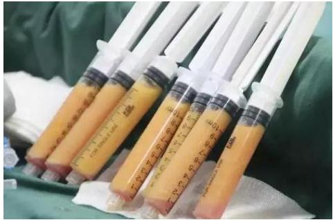 做自體脂肪填充臉部術(shù)后8天可以化妝嗎?