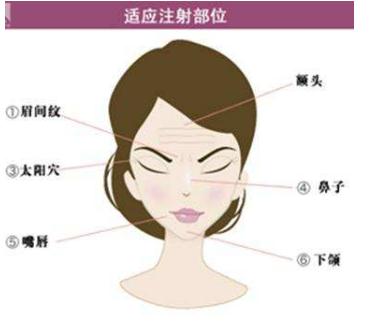 玻尿酸注射除皺的果能保持多久?