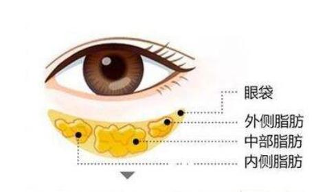 眼袋抽脂術(shù)的原理