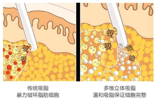 眼袋抽脂術(shù)的優(yōu)勢(shì)