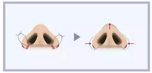 鼻頭縮小手術后遺癥