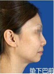 與求美者自己體質(zhì)有關(guān)