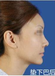 與求美者自己體質(zhì)有關(guān)