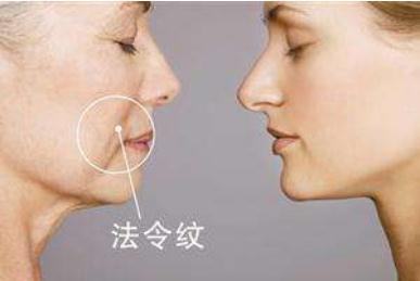有法令紋的苦惱？哪些方法能夠消除法令紋？