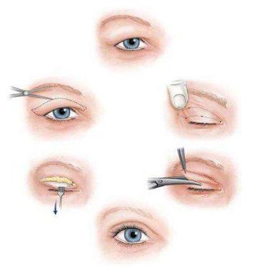 雙眼皮失敗間隔多長(zhǎng)時(shí)間能夠再次做?