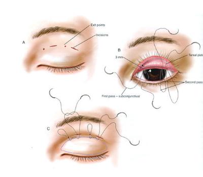 眼部手術一般多少錢?