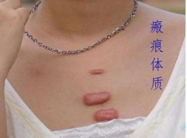 一般做瘢痕修復(fù)的手術(shù)的花費是多少？