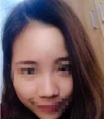 長春假體隆鼻手術(shù)術(shù)前