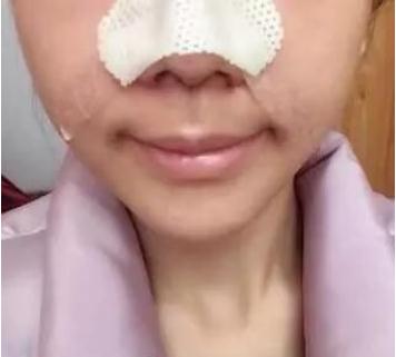 長春假體隆鼻手術(shù)術(shù)后第3天