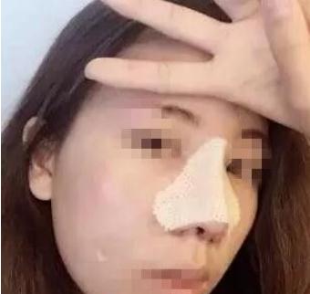長春假體隆鼻手術(shù)術(shù)后第7天