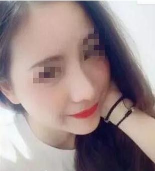 長春假體隆鼻手術(shù)術(shù)后一個(gè)月