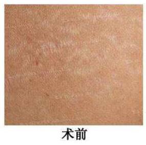 激光去除妊娠紋的果