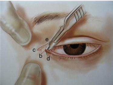 開眼角多久能恢復(fù)?