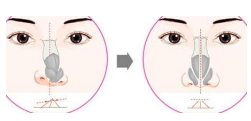 做歪鼻矯正手術(shù)CG高嗎？CG是多少？