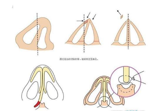 歪鼻矯正的CG是多少？