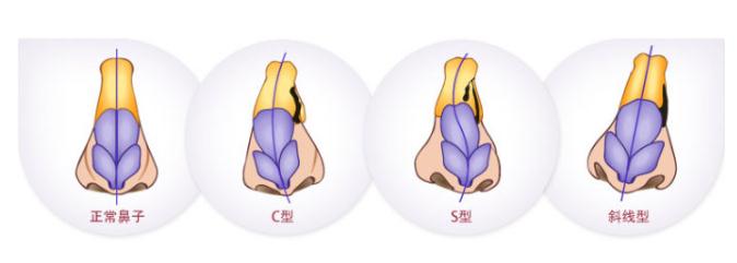 歪鼻子矯正的果是否自然？