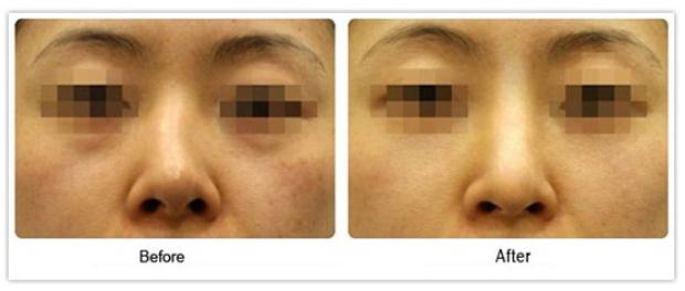 歪鼻子矯正的果是否自然？