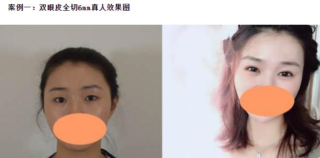雙眼皮6 7 8毫米的區(qū)別，割雙眼皮多寬才好看？