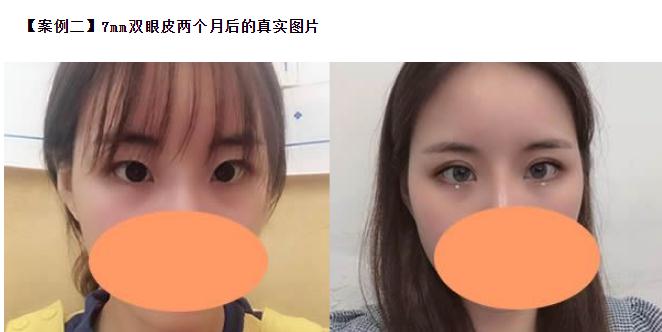 雙眼皮6 7 8毫米的區(qū)別，割雙眼皮多寬才好看？
