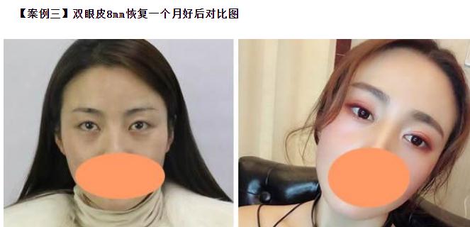 雙眼皮6 7 8毫米的區(qū)別，割雙眼皮多寬才好看？