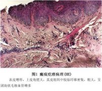 有瘢痕疙瘩怎么辦？該怎么調(diào)節(jié)？