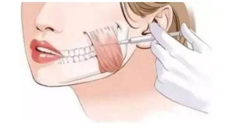 注射瘦臉的果能夠維持多長時間?