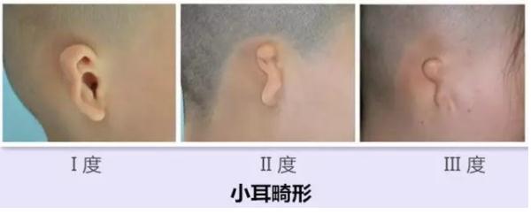 什么原因導致寶寶的耳廓形態(tài)畸形呢?