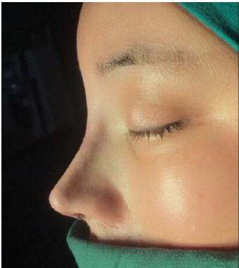 肋骨隆鼻能保持多久？