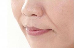 做玻尿酸除法令紋的果怎么樣？