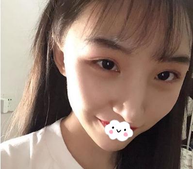 做顴骨內(nèi)推手術(shù)術(shù)后一個(gè)月