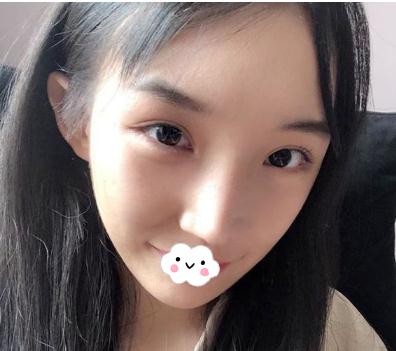 做顴骨內(nèi)推手術(shù)術(shù)后三個(gè)月