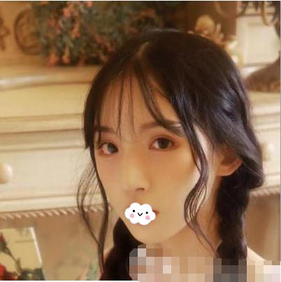 做顴骨內(nèi)推手術(shù)術(shù)后半年