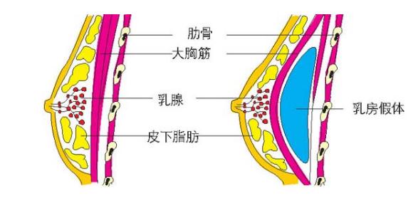 假體隆胸手術(shù)大概得要多少錢?