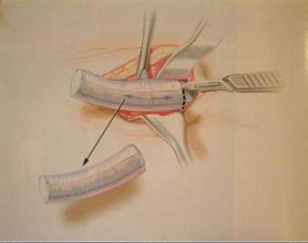 肋軟骨隆鼻的缺點(diǎn)