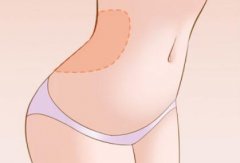 韓國做腰腹環(huán)吸包含哪些部位？是怎么收費(fèi)的？