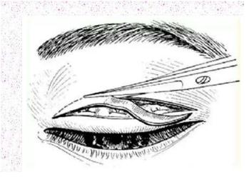 全切雙眼皮感染的表現(xiàn)