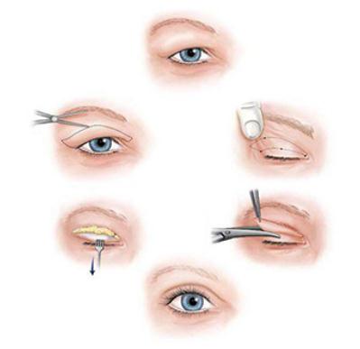 在夏季做雙眼皮手術(shù)傷口會更容易發(fā)炎感染?