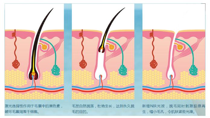 在整形美容機(jī)構(gòu)做腋毛去除項目的果怎么樣?