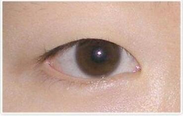 開眼角有什么害處?