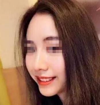 長春假體隆鼻手術(shù)術(shù)后半年